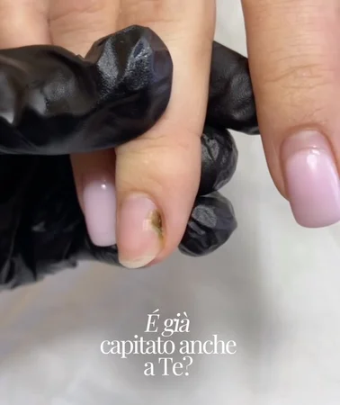  Pseudomonas. Uno dei problemi più frequenti che ogni onicotecnica, prima o poi, si trova ad affrontare.
E non venirmi a dire che non ti è mai capitato.
Capita alle principianti e alle professioniste con anni di esperienza. A chi sterilizza correttamen